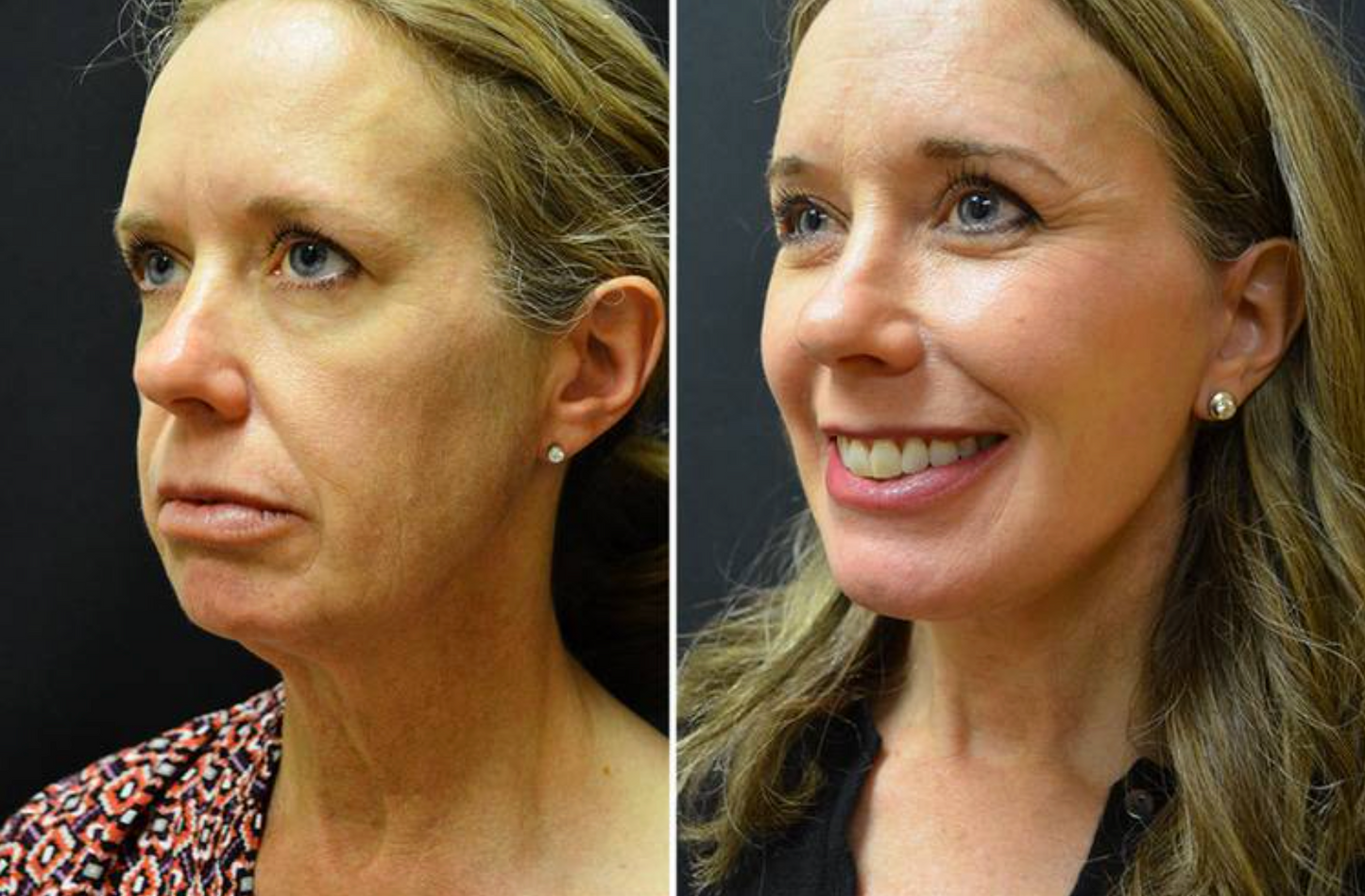 NeckLift 7X- Slim Facial Lifting Massager